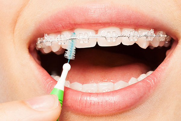 Clear Braces: What Are They?