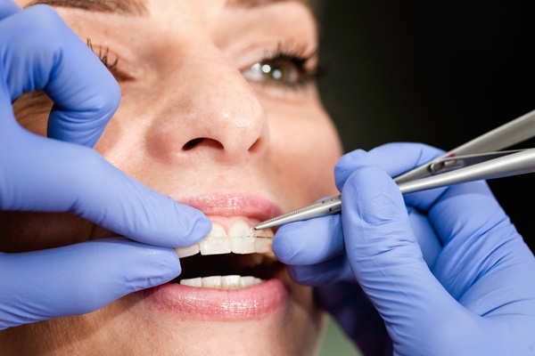 Why Should I Consider Clear Braces?