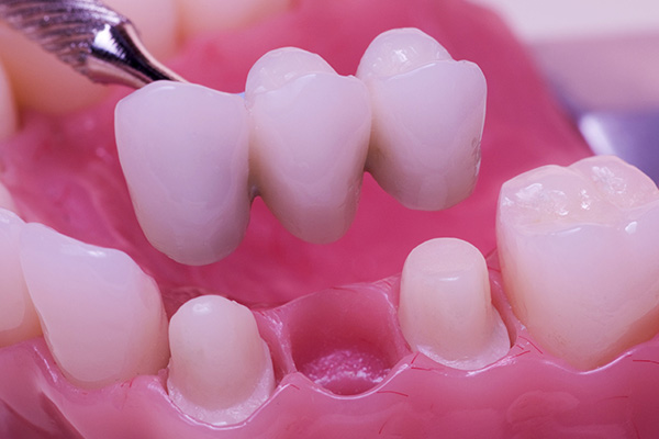 How A Dental Bridge Can Help Replace Missing Teeth
