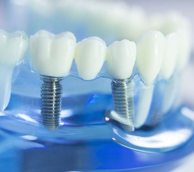 Oak Ridge Dental Implants