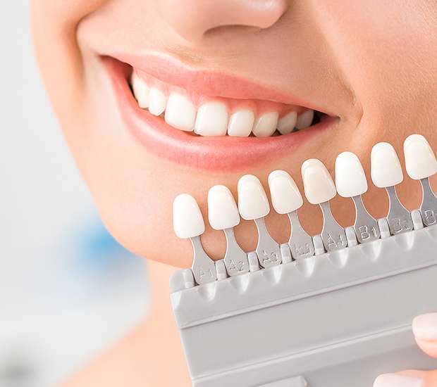 Oak Ridge Dental Veneers and Dental Laminates