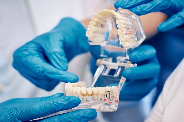 Implant Supported Dentures: Can They Successfully Replace Upper Teeth?