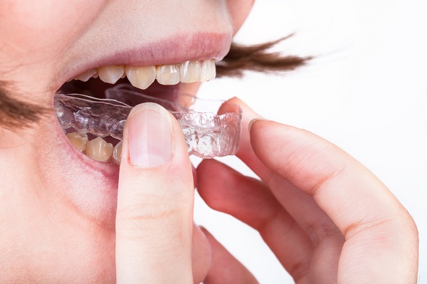 Invisalign braces - Colton Modern Dentistry