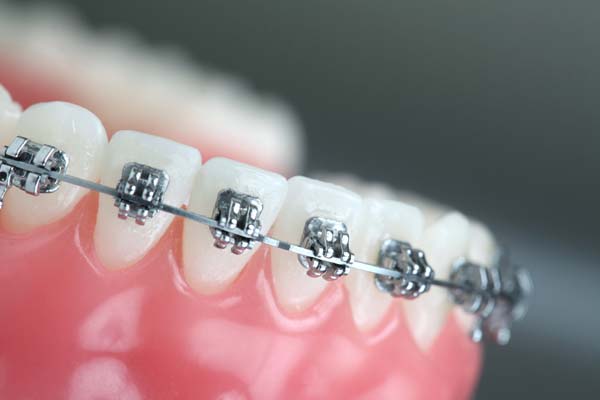 Orthodontics: How Do Clear Braces Work To Straighten Teeth?