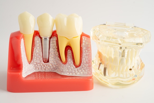How Soon Can You Get Tooth Implants  After Extraction?