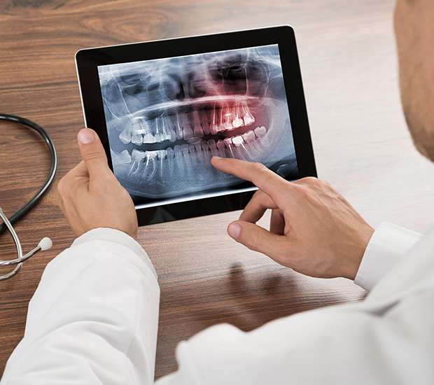 Oak Ridge Types of Dental Root Fractures